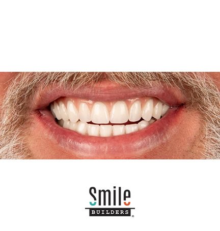 smile-builders-dental-after-patient-tijuana-mexico-1