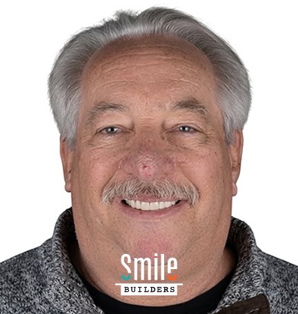 smile-builders-dental-after-patient-tijuana-mexico-2