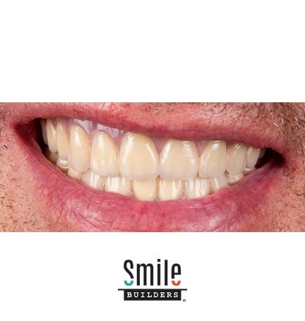 smile-builders-dental-after-patient-tijuana-mexico-3