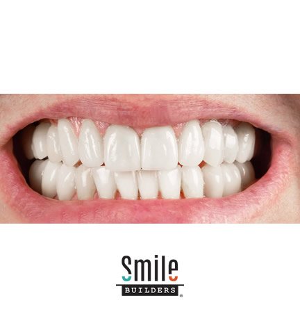 smile-builders-dental-after-patient-tijuana-mexico-5