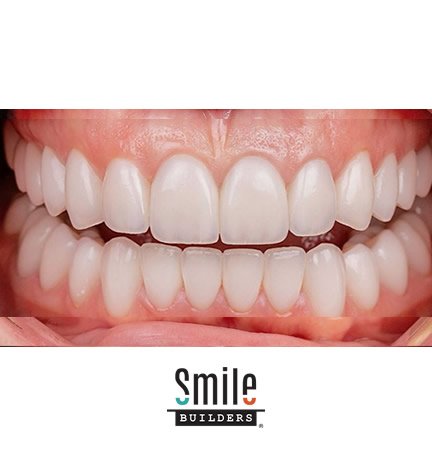 smile-builders-dental-after-patient-tijuana-mexico-7