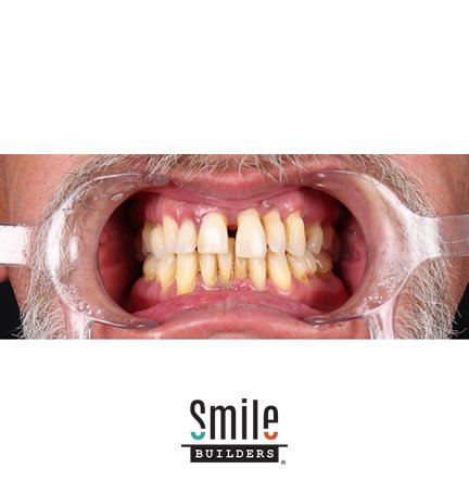smile-builders-dental-before-patient-tijuana-mexico-1 smile-builders-dental-before-patient-tijuana-mexico-1