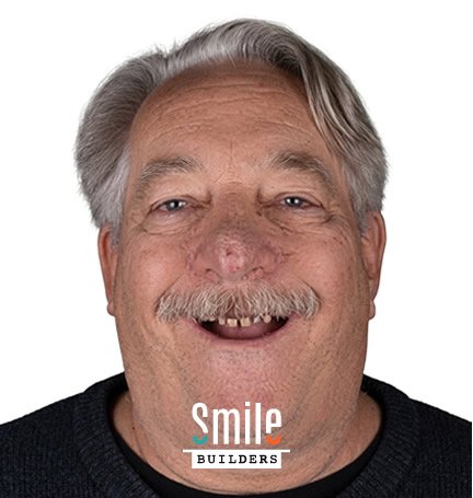smile-builders-dental-before-patient-tijuana-mexico-2 smile-builders-dental-before-patient-tijuana-mexico-2