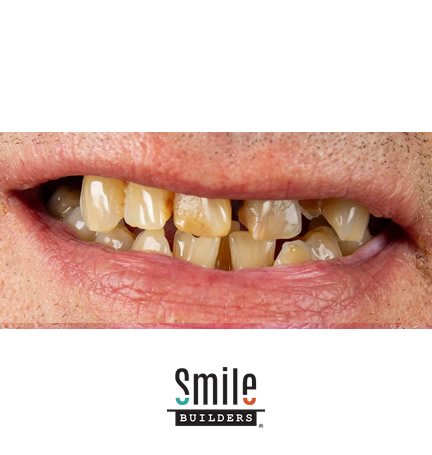 smile-builders-dental-before-patient-tijuana-mexico-3 smile-builders-dental-before-patient-tijuana-mexico-3