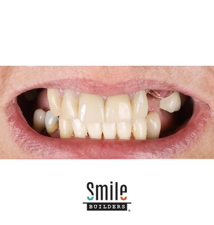 smile-builders-dental-before-patient-tijuana-mexico-5 smile-builders-dental-before-patient-tijuana-mexico-5