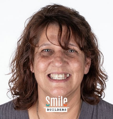 smile-builders-dental-before-patient-tijuana-mexico-6 smile-builders-dental-before-patient-tijuana-mexico-6
