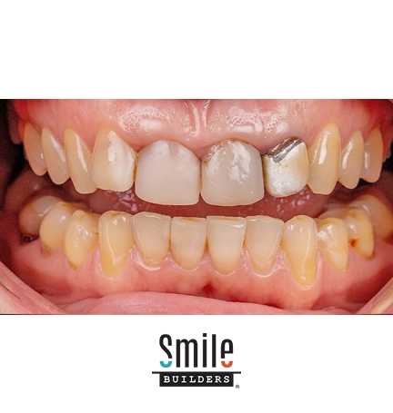 smile-builders-dental-before-patient-tijuana-mexico-7 smile-builders-dental-before-patient-tijuana-mexico-7