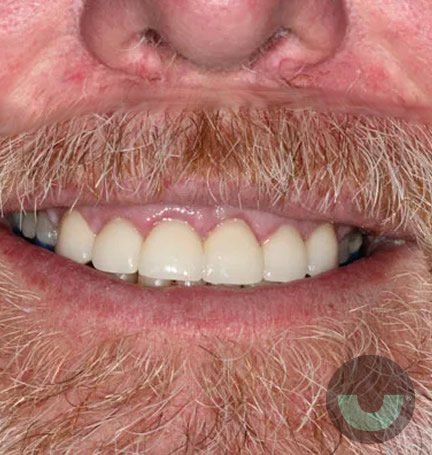 smile-builders-dental-veneers-after-2-tijuana-mexico