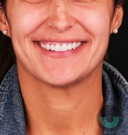 smile-builders-dental-veneers-after-3-tijuana-mexico