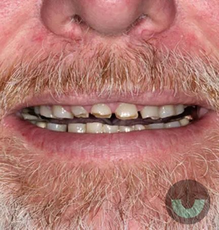 smile-builders-dental-veneers-before-2-tijuana-mexico smile-builders-dental-veneers-before-2-tijuana-mexico