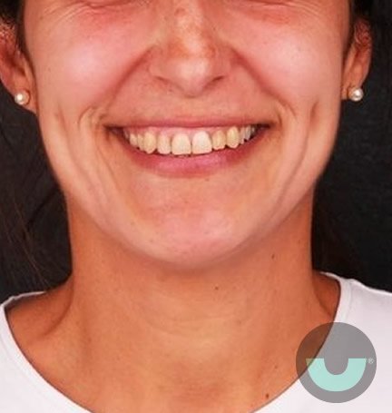 smile-builders-dental-veneers-before-3-tijuana-mexico smile-builders-dental-veneers-before-3-tijuana-mexico