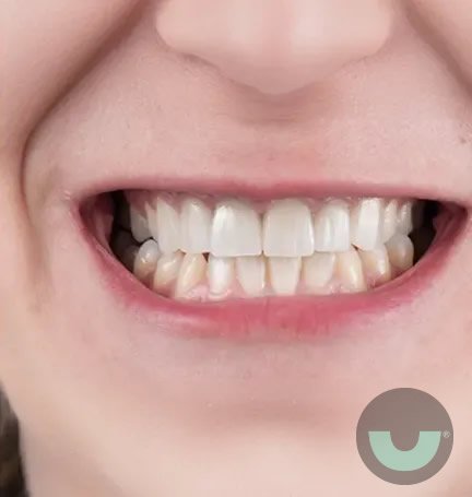 smile-builders-dental-veneers-before-after-2-tijuana-mexico