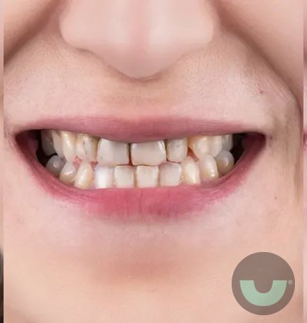 smile-builders-dental-veneers-before-before-1-tijuana-mexico smile-builders-dental-veneers-before-before-1-tijuana-mexico