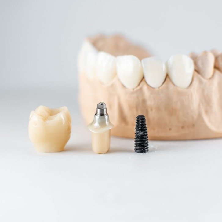 🦷✨ Restore Your Smile with Implant Crowns

Natural-looking, durable, and designed for confidence.
At Smile Builders, we create beautiful smiles that look and feel like real teeth.

✔ Natural Appearance
✔ Strong & Long-Lasting
✔ Comfortable Fit
✔ Smile with Confidence Again
✔ Warranty included on our treatments
✔ Transportation available from the border to our clinic 🚘

📍High-quality dental care at affordable prices.
📲 Schedule your consultation today!