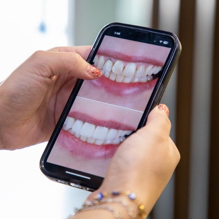 ✨ Transform Your Smile in Just One Visit! ✨

Dreaming of a brighter, more confident smile? 🦷✨

Our composite resin veneers are a conservative and affordable way to enhance your smile while maintaining a natural look.

They can help correct:
✔️ Chipped or worn teeth
✔️ Gaps between teeth
✔️ Stains and discoloration
✔️ Uneven shapes and sizes
✔️ Minor imperfections

💎 Natural-looking results.
💎 Minimally invasive treatment.
💎 Same-day smile transformation in many cases.

📍 Located just minutes from the San Ysidro border in Tijuana.
🚗 We offer complimentary transportation from the border to our clinic.

📞 Schedule your consultation today and let us help you achieve the smile you've always wanted!

📍 Av. Revolución 993, Zona Centro, Tijuana, B.C.
📞 USA: (619) 259-6751
📞 Mexico: (664) 359-5076

Your new smile starts here! 😁✨

#SmileBuilders #CompositeVeneers #SmileMakeover #CosmeticDentistry #TijuanaDentist #DentalTourism #BeautifulSmile #NaturalResults #JustMinutesFromTheBorder #freetransportation