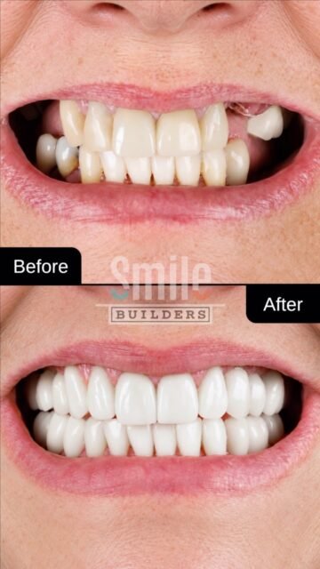 Full Mouth Rehabilitation with Dental Implants & Crowns.

When multiple teeth are missing, damaged, or severely worn, combining dental implants with custom crowns can help rebuild both function and appearance.

Dental implants replace missing teeth with a stable foundation, while crowns restore the shape, strength, and natural look of compromised teeth. Together, they can improve the bite, chewing ability, smile balance, and overall confidence.

Every case is individually planned to create a result that looks natural and functions properly.

Contact Smile Builders to schedule your evaluation.

#SmileBuilders #DentalImplants #DentalCrowns #FullMouthRehabilitation