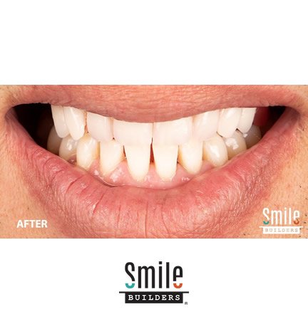 smile-builders-dental-after-patient-tijuana-mexico-al-on-4-1