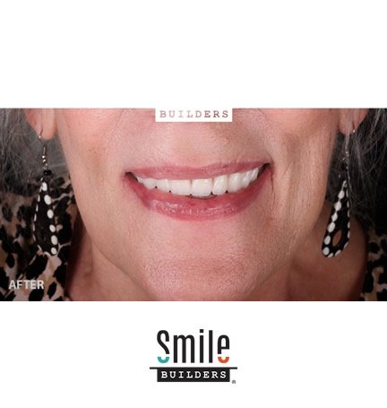 smile-builders-dental-after-patient-tijuana-mexico-all-on-4-2