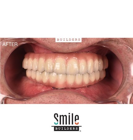 smile-builders-dental-after-patient-tijuana-mexico-all-on-4-3