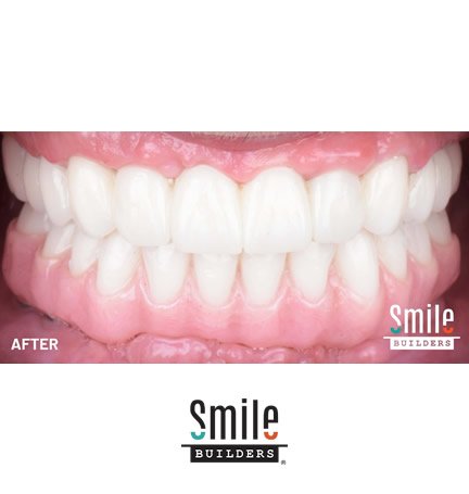 smile-builders-dental-after-patient-tijuana-mexico-all-on-4-4