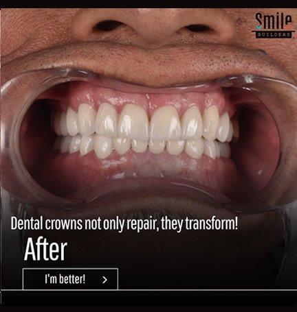 smile-builders-dental-after-patient-tijuana-mexico-dental-crowns-1