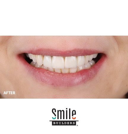 smile-builders-dental-after-patient-tijuana-mexico-dental-crowns-2