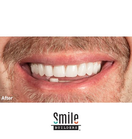 smile-builders-dental-after-patient-tijuana-mexico-dental-implants-1