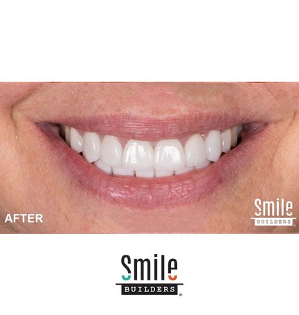 smile-builders-dental-after-patient-tijuana-mexico-veneers-1