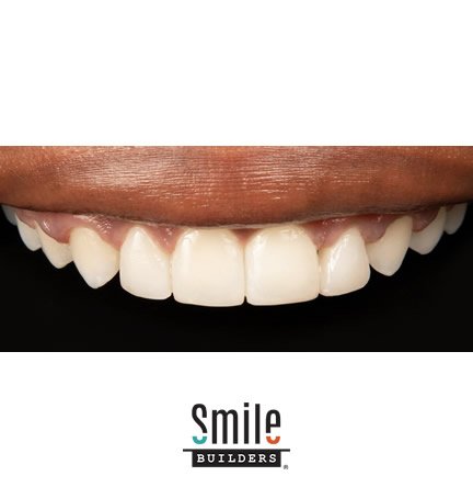 smile-builders-dental-after-patient-tijuana-mexico-veneers-2