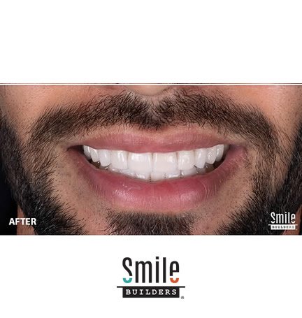 smile-builders-dental-after-patient-tijuana-mexico-veneers-3