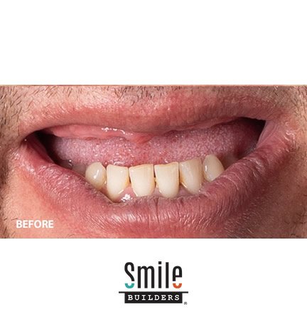 smile-builders-dental-before-patient-tijuana-mexico-al-on-4-1 smile-builders-dental-before-patient-tijuana-mexico-al-on-4-1