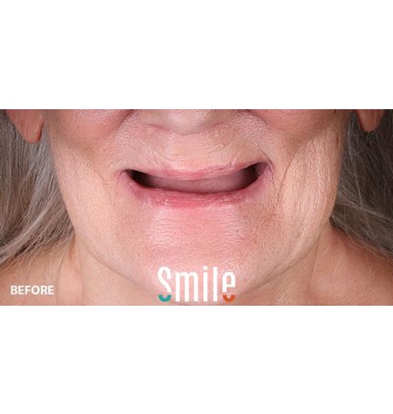 smile-builders-dental-before-patient-tijuana-mexico-all-on-4-2 smile-builders-dental-before-patient-tijuana-mexico-all-on-4-2
