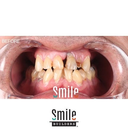 smile-builders-dental-before-patient-tijuana-mexico-all-on-4-3 smile-builders-dental-before-patient-tijuana-mexico-all-on-4-3