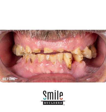smile-builders-dental-before-patient-tijuana-mexico-all-on-4-4 smile-builders-dental-before-patient-tijuana-mexico-all-on-4-4
