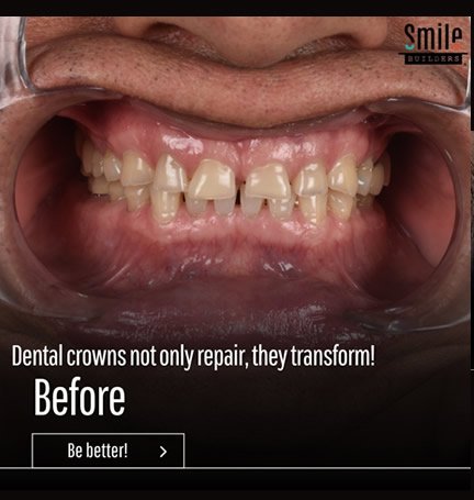 smile-builders-dental-before-patient-tijuana-mexico-dental-crowns-1 smile-builders-dental-before-patient-tijuana-mexico-dental-crowns-1