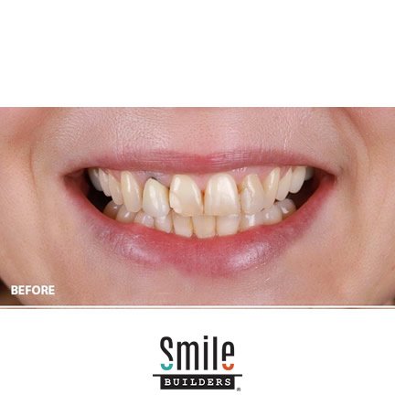 smile-builders-dental-before-patient-tijuana-mexico-dental-crowns-2 smile-builders-dental-before-patient-tijuana-mexico-dental-crowns-2