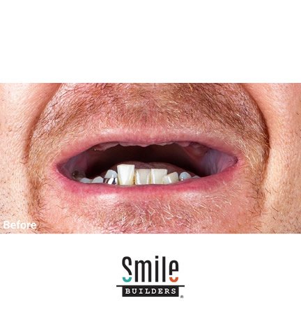 smile-builders-dental-before-patient-tijuana-mexico-dental-implants-1