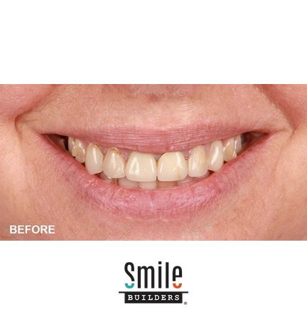 smile-builders-dental-before-patient-tijuana-mexico-veneers-1 smile-builders-dental-before-patient-tijuana-mexico-veneers-1