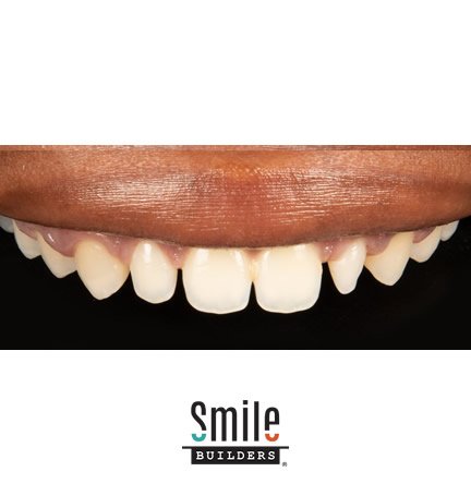 smile-builders-dental-before-patient-tijuana-mexico-veneers-2 smile-builders-dental-before-patient-tijuana-mexico-veneers-2