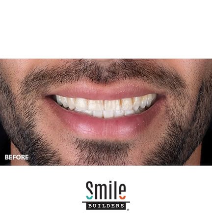 smile-builders-dental-before-patient-tijuana-mexico-veneers-3 smile-builders-dental-before-patient-tijuana-mexico-veneers-3